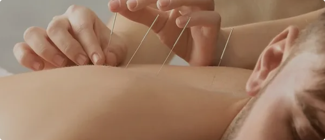 Dry Needling